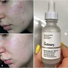 The Ordinary Niacinamide 10% + Zinc 1 % – 20 ml | Oil Control, Pore Minimizing & Blemish Solution Serum